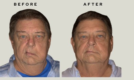 Before and after comparison of a Bell's palsy patient showing markedly improved facial symmetry after six EMFACE treatments