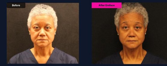 EMFACE before and after: Karen G., age 63, showing firmer, more lifted facial contours after non-surgical facial tightening