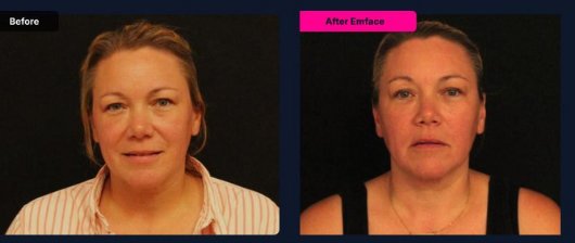 EMFACE before and after: Kelly A., age 44, showing smoother skin and a more contoured jawline after non-surgical face lift treatments