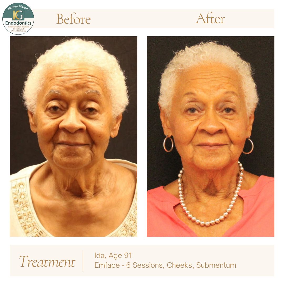 EMFACE before and after: Ida G., age 91, showing lifted cheeks and a tighter jawline after six non-surgical face lift sessions